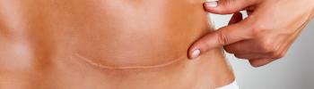 Cómo afecta la cicatriz de cesárea al suelo pélvico y qué puede hacer la fisioterapia por ti
