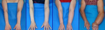 Linfedema en miembro superior secundario el tratamiento de cáncer de mama - FisioClinics Logroño