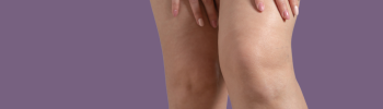 Retención de líquidos y edema en piernas: causas frecuentes y cómo mejorar la circulación