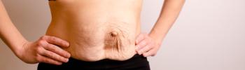 Tratamiento de la diástasis abdominal: abordaje progresivo para mejorar el abdomen Tratamiento de la diástasis abdominal: abordaje progresivo para mejorar el abdomen