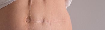 Osteopatía Visceral en la Rehabilitación Postoperatoria: Apoyo para la Recuperación de Cirugías Abdominales
