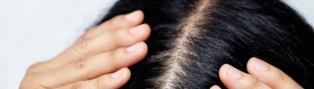 INDIBA para alopecia areata: ¿Es efectivo este tratamiento?