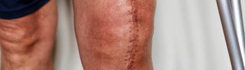 Rehabilitación después de una cirugía por tendinitis rotuliana.
