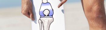 Fortalecimiento muscular específico para la artrosis de rodilla