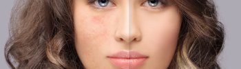 ¿Qué es la radiofrecuencia facial indiba y en qué nos puede ayudar?