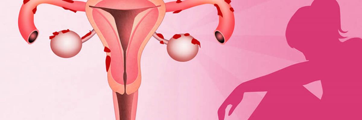 Abordaje integral en pacientes con endometriosis 