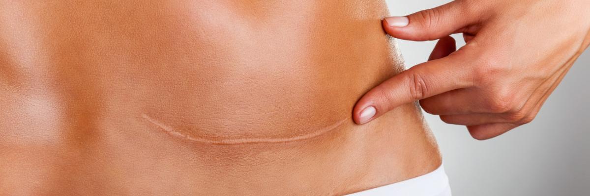Cómo afecta la cicatriz de cesárea al suelo pélvico y qué puede hacer la fisioterapia por ti