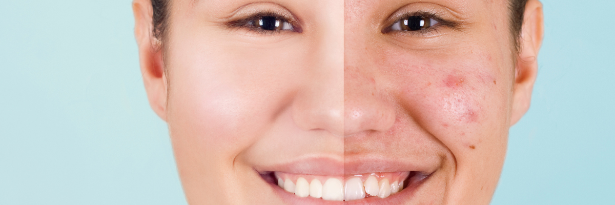 Cómo funciona la rdiofrecuencia facial INDIBA en el tratamiento del acné