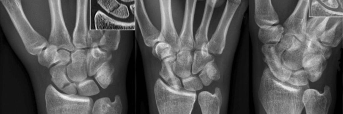 Recuperación funcional tras fractura de escafoides: guía práctica