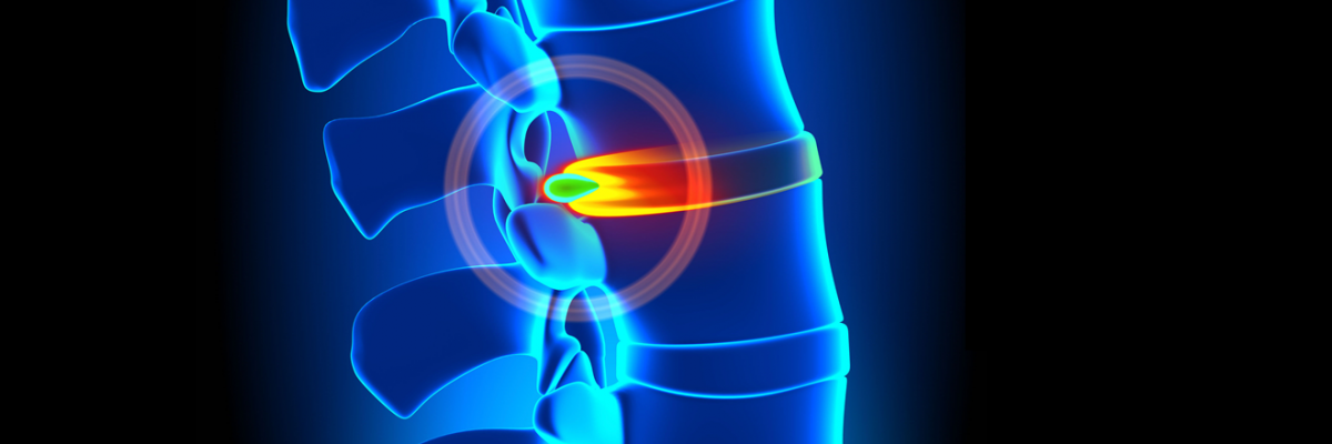 Todo sobre el segmento vertebral L5-S1 (articulación lumbosacra