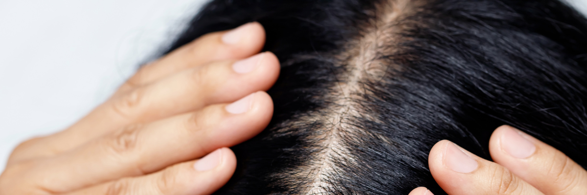 INDIBA para alopecia areata: ¿Es efectivo este tratamiento?