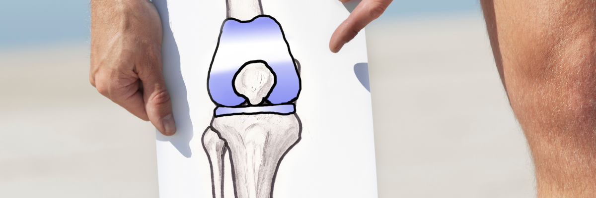 Fortalecimiento muscular específico para la artrosis de rodilla