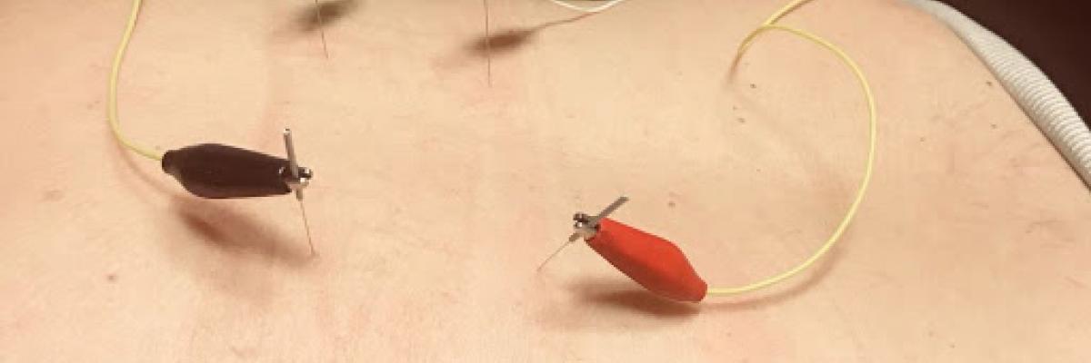 Electroneuroacupuntura: La Acupuntura desde una Perspectiva Anatómica y Neurofisiológica