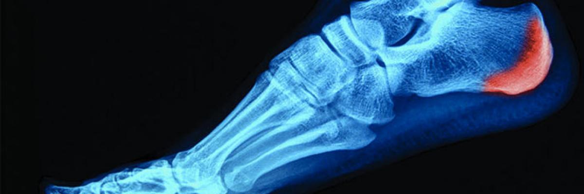 ¿Cuál es el tratamiento a través de la fisioterapia para la fascitis plantar y el espolón calcáneo?  -  FisioClinics Logroño ¿Cuál es el tratamiento a través de la fisioterapia para la fascitis plantar y el espolón calcáneo?  -  FisioClinics Logroño