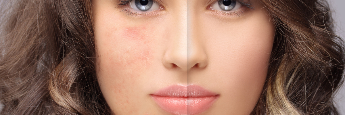 Descubre la Revolución de la Belleza: La Magia de la Radiofrecuencia Estética