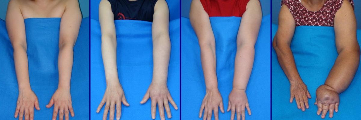 Linfedema en miembro superior secundario el tratamiento de cáncer de mama - FisioClinics Logroño Linfedema en miembro superior secundario el tratamiento de cáncer de mama - FisioClinics Logroño