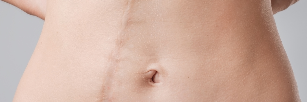 Cómo la radiofrecuencia corporal Indiba mejora la cicatrización de heridas y acelerar la recuperación en general