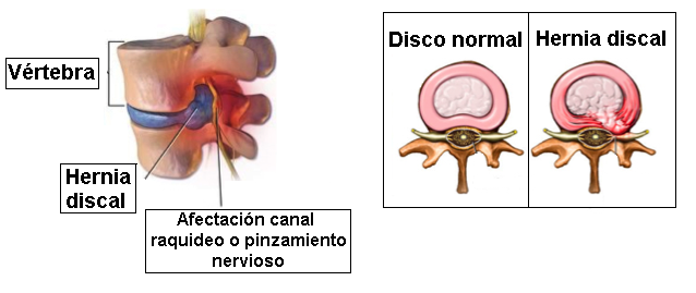 Qué es la hernia discal L4-L5 con o sin ciática, por qué se produce y que  tratamiento hacemos en FisioClinics Logroño